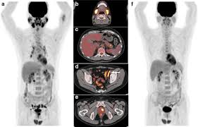 PET-CT cost in China for foreign patients