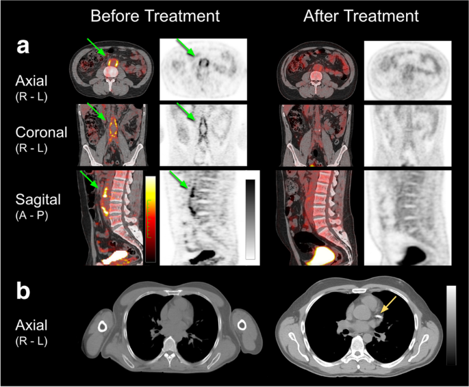 Same-day PET-CT in China for foreign patients